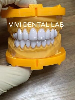 Super Branco E Max Veneers Laminado Dental Profissional Alta Estética