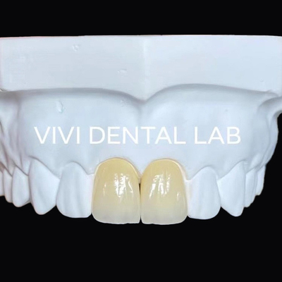 Implante de ponte de zircônia dentária de mandíbula completa coroa translúcida estética