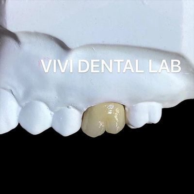 Be Ni Free Metal Porcelana Coroas PFM Coroa China Laboratório Dental