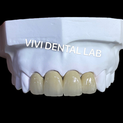PFM Coroas Dentárias de Laboratório Técnica SLM Com Scheftner 30 Alloy Powder