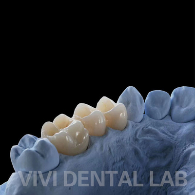 Coroas de laboratório dentário de contorno completo de alta translucidez