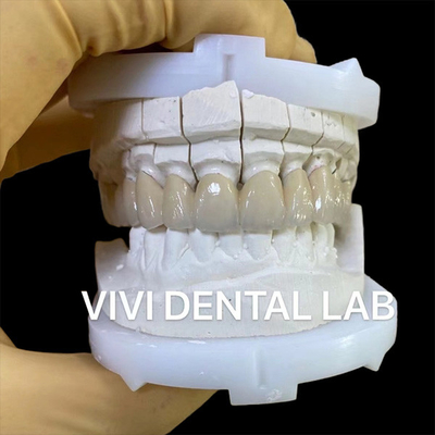 Coroas de laboratório dentário de precisão Estética de porcelana Coroa dentária de zircônia