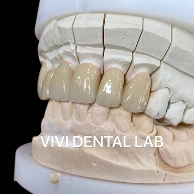 Coroas de laboratório dentário telescópico de camada única Zirconia Noritake porcelana