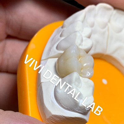 O laboratório dental contínuo coroa o pro Translucency que 3D alto a zircônia completa coroa o laboratório dental de China