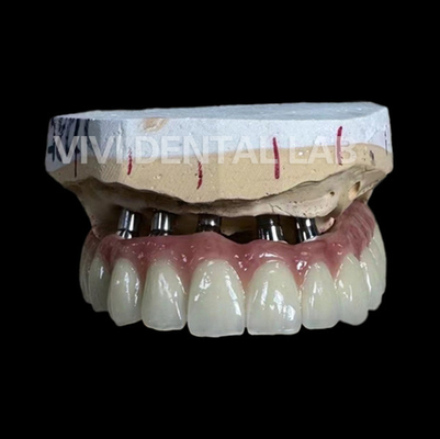 Laboratório dental de China da ponte total do implante PFM
