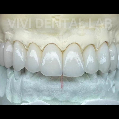 Laboratório Dentário Coroas e Pontes de Zirconia Profissional Estável