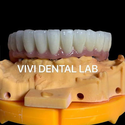 Coroas Dentárias Digitais Estéticas Implante Dental Translúcido Coroa