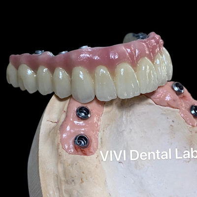 Coroa de implante dentário de alta estética / coroa retida por parafuso aprovada pela ISO