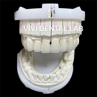 Alta Estética Coroas de Laboratório Dental de Zirconia Ponte Com Porcelana em Camadas