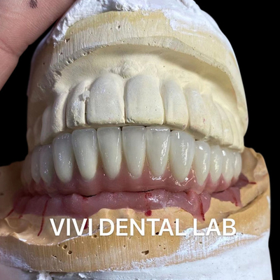 Implante Dental Ponte Cerâmica de Metal em Abutments de Titânio