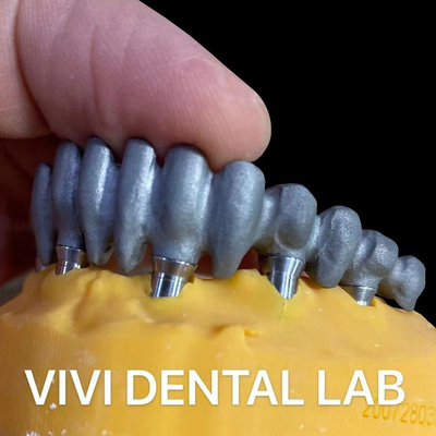 Ponte impressa de PFM sobre abutments de várias unidades do laboratório dentário da China