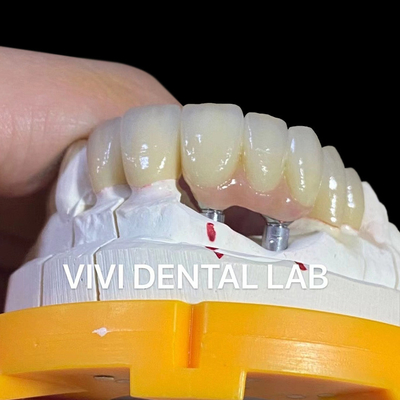Porcelana Zirconia Implantação Dental Ponte Profissional Alta Estética