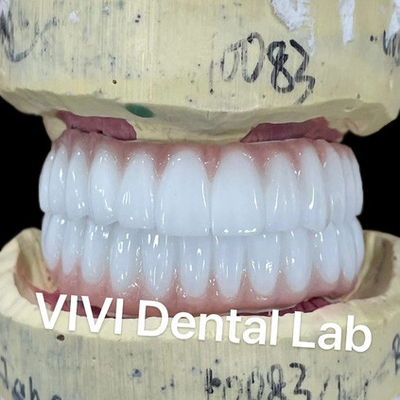 Ni Be Free Zirconia Implante Dental Ponte Sobre Bar Alta Estética