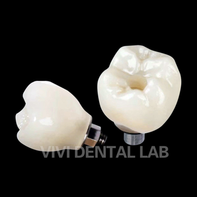 Implantação dental retida por parafuso coroa PFZ porcelana em camadas de zircônio