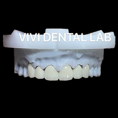 Ponte de zircônio dental anterior Certificado ISO Tempo de resposta rápido