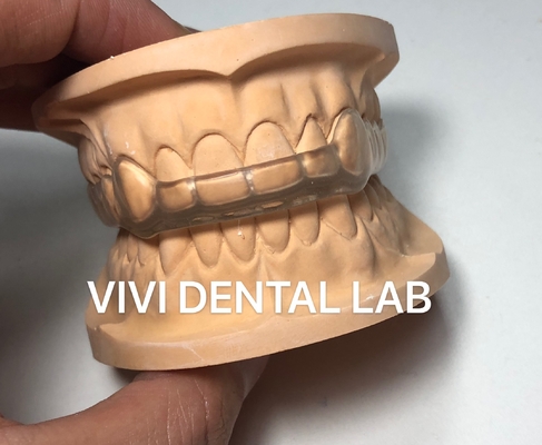 Proteção bucal dental noturna Espinha oclusal Ekodent Bom ajuste Alta estética