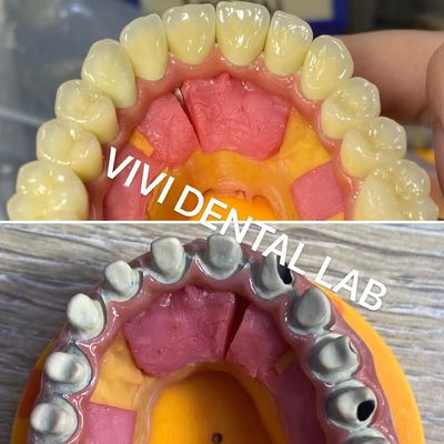 Ivoclar Digital Dental Crowns Process Noritake Porcelana Alta precisão