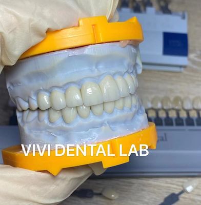 A estratificação estética alta de Emax dos dentes folheia o laboratório dental de China do Translucency incisivo