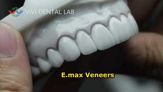 Laminados para facetas dentárias