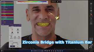Barra de titânio Zirconia Bridge All on X Solution